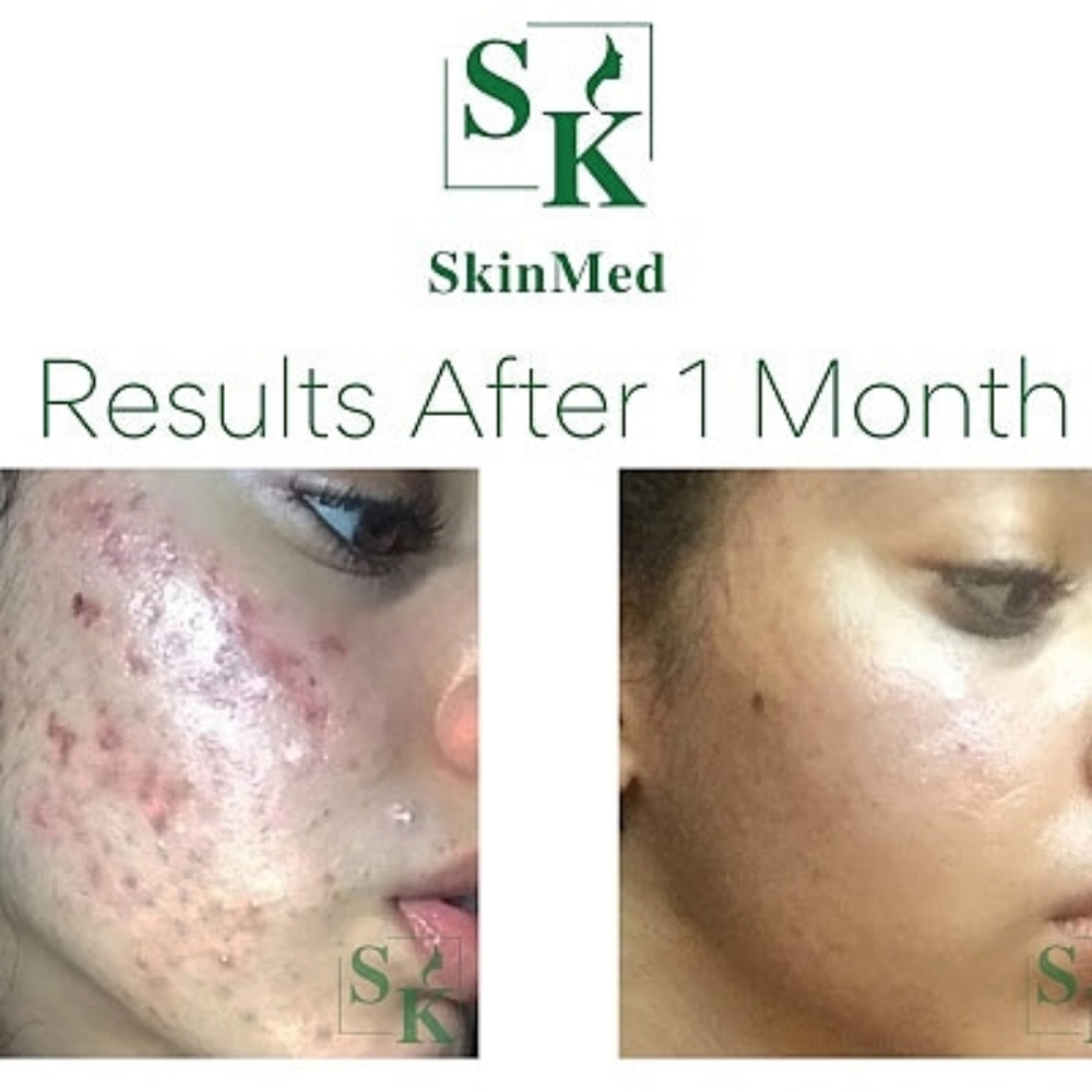 ACNE PIMPLES DARK SPOTS TREATMENTS